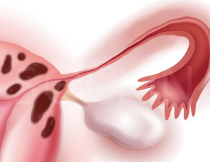 Adenomyosis