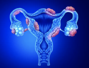 Fibroid Uterus