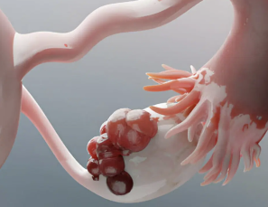 Ovarian Cyst