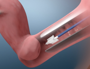 Pap Smear HPV test